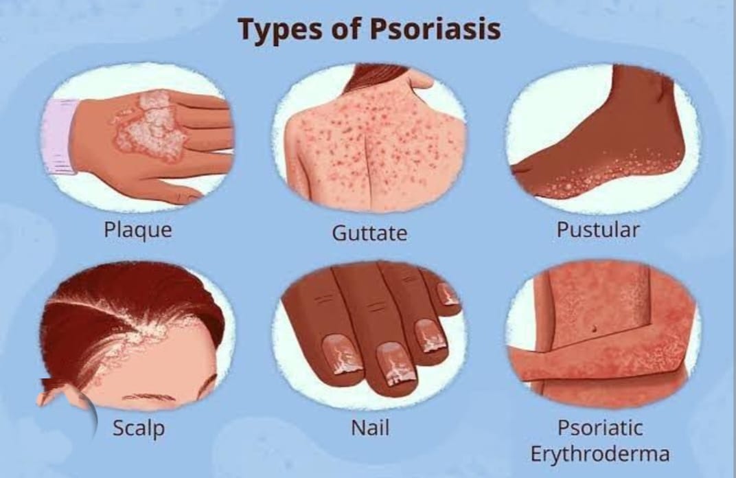 Psoriasis Types